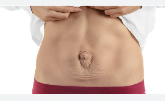 Diastasis Rekti (Karın Kasları Ayrılması): Bilmeniz Gereken Her Şey